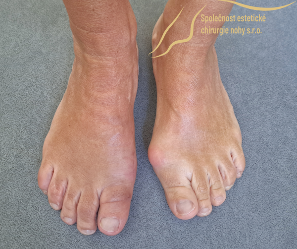 pooperační fotka vbočeného palce pravé nohy 12 týdnů po operaci